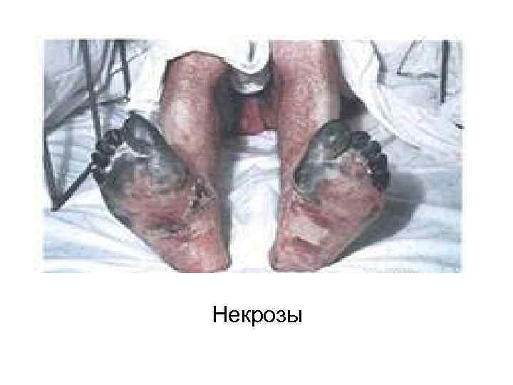 Некрозы 
