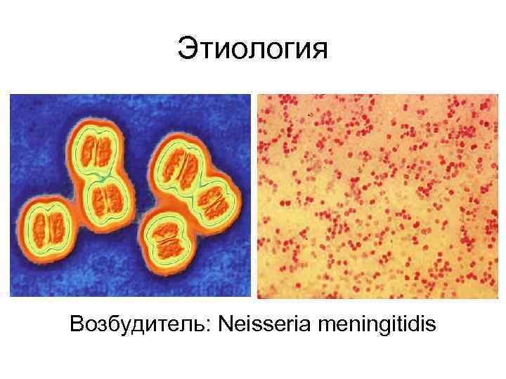    Этиология Возбудитель: Neisseria meningitidis 