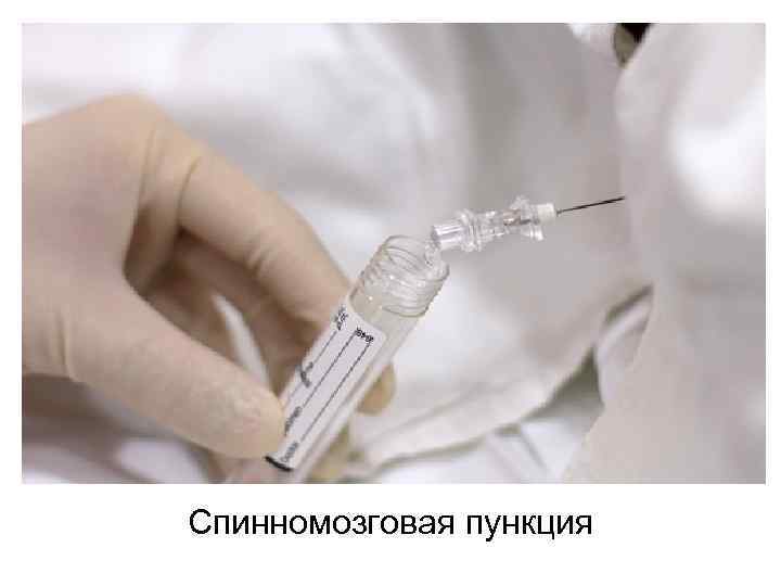 Спинномозговая пункция 