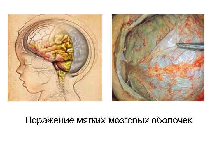 Поражение мягких мозговых оболочек 