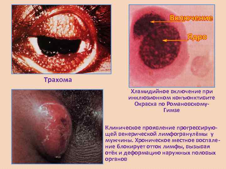 Трахома    Хламидийное включение при    инклюзионном конъюнктивите  