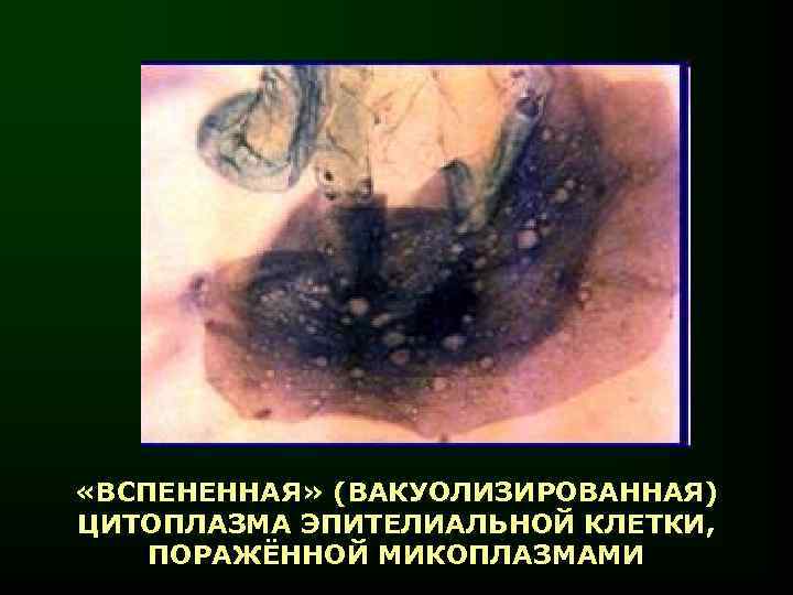  «ВСПЕНЕННАЯ» (ВАКУОЛИЗИРОВАННАЯ) ЦИТОПЛАЗМА ЭПИТЕЛИАЛЬНОЙ КЛЕТКИ, ПОРАЖЁННОЙ МИКОПЛАЗМАМИ 