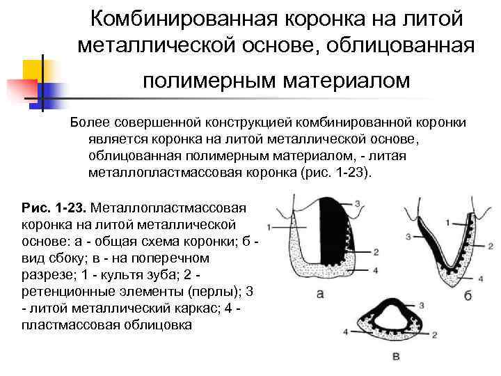    Комбинированная коронка на литой   металлической основе, облицованная  