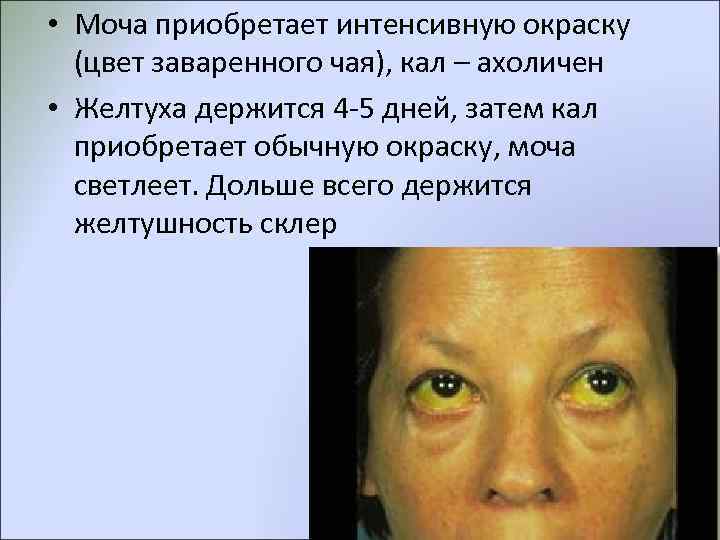 • Моча приобретает интенсивную окраску  (цвет заваренного чая), кал – ахоличен •