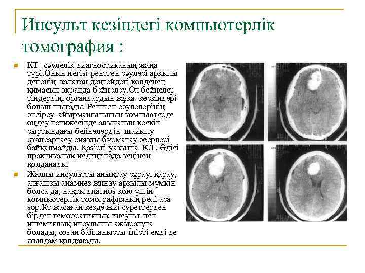   Инсульт кезіндегі компьютерлік томография : n  КТ- сәулелік диагностиканың жаңа түрі.