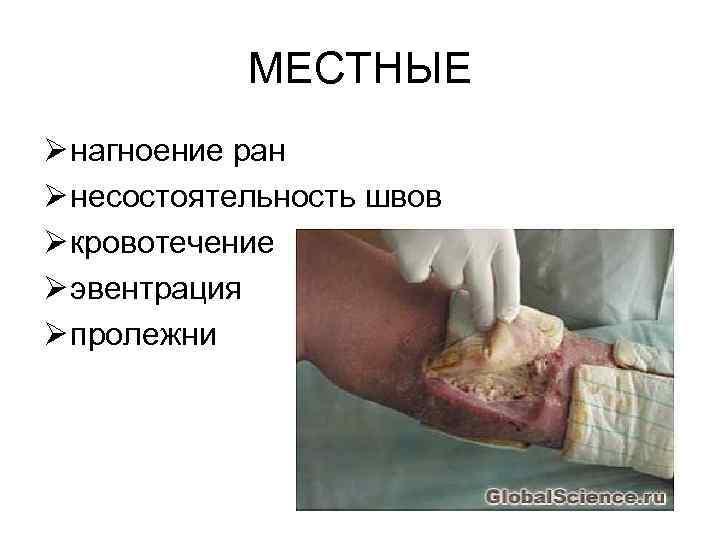   МЕСТНЫЕ Ø нагноение ран Ø несостоятельность швов Ø кровотечение Ø эвентрация Ø