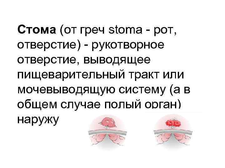 Стома (от греч stoma - рот,  отверстие) - рукотворное отверстие, выводящее пищеварительный тракт