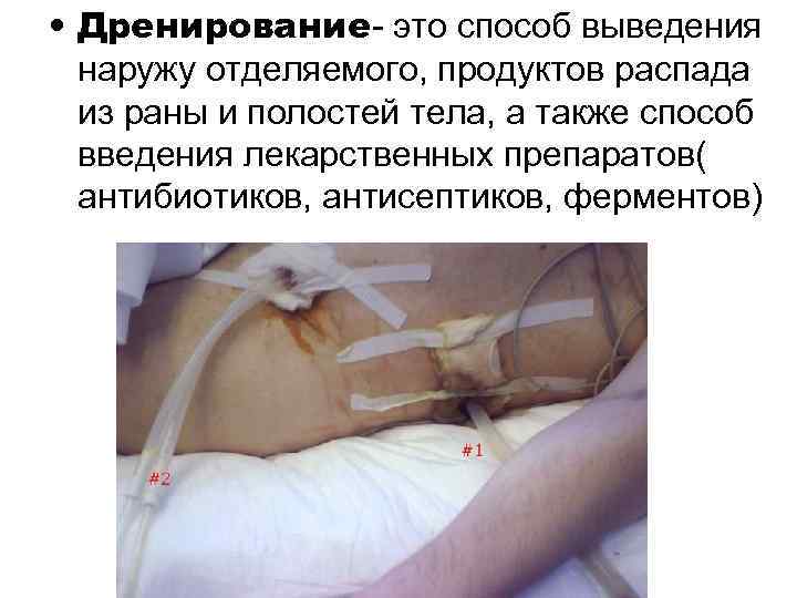  • Дренирование- это способ выведения  наружу отделяемого, продуктов распада  из раны