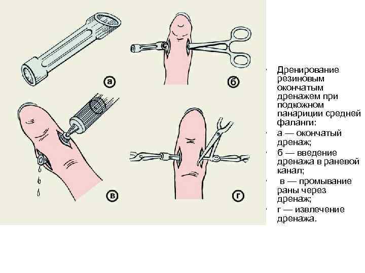  •  Дренирование резиновым окончатым дренажем при подкожном панариции средней фаланги:  •