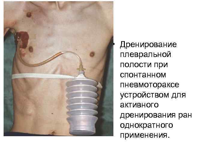  • Дренирование  плевральной  полости при  спонтанном  пневмотораксе  устройством