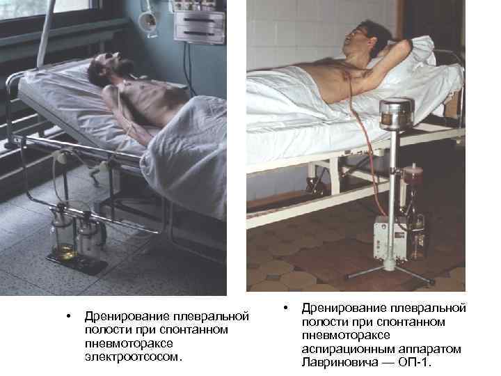        •  Дренирование плевральной  полости при
