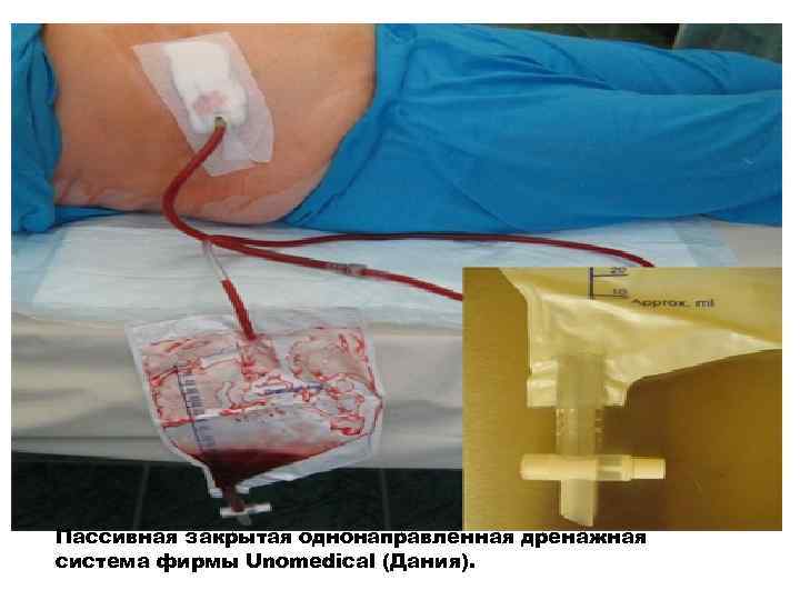 Пассивная закрытая однонаправленная дренажная система фирмы Unomedical (Дания). 