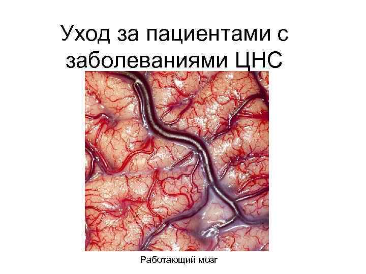 Уход за пациентами с заболеваниями ЦНС  Работающий мозг 