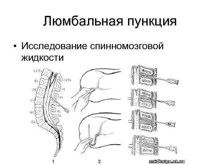 Картина спинномозговой жидкости при менингококковом менингите