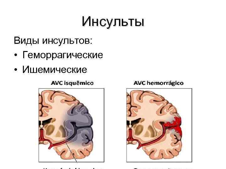 Виды инсульта. Инсульт бывает. Инсульт виды и последствия. Какие бывают инсульты виды.