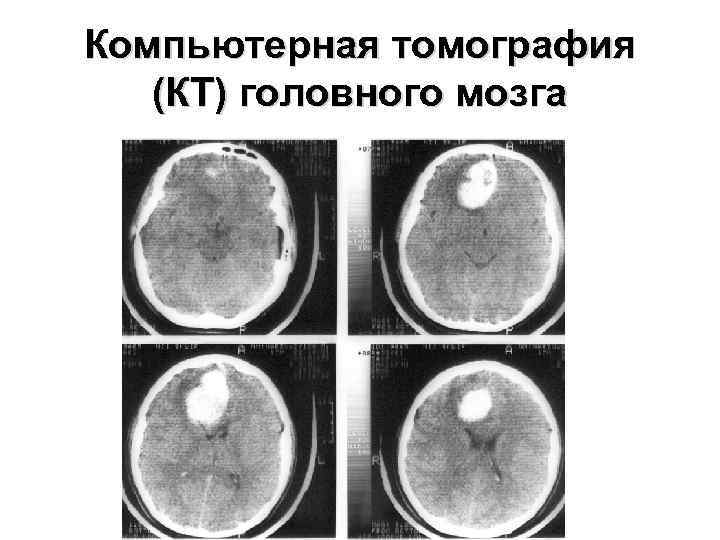 Компьютерная томография  (КТ) головного мозга 