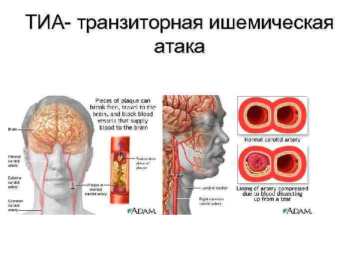 Карта вызова смп транзиторная ишемическая атака