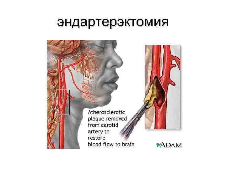 эндартерэктомия 