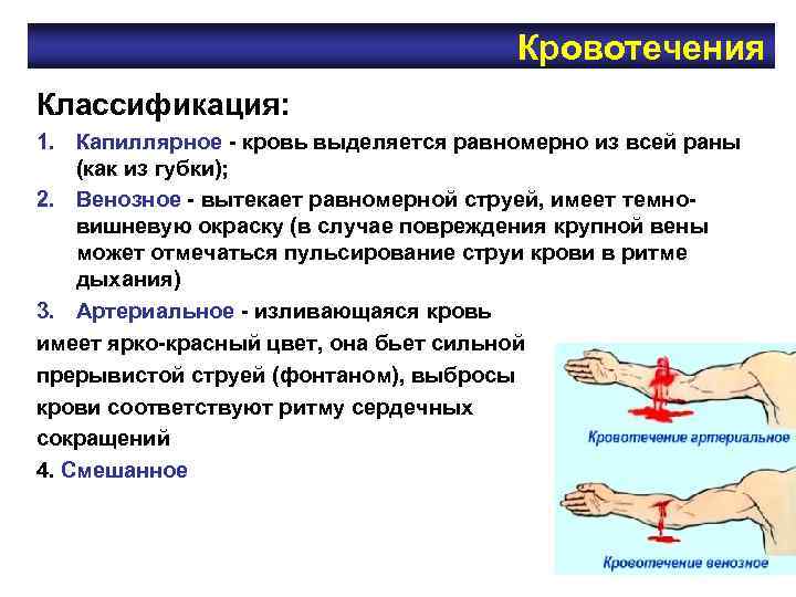 Кровотечения Классификация: 1. Капиллярное - кровь выделяется равномерно из всей Кровотечения Классификация: 1. Капиллярное - кровь выделяется равномерно из всей