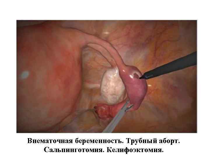 Внематочная беременность. Трубный аборт. Сальпинготомия. Келифоэктомия. Внематочная беременность. Трубный аборт. Сальпинготомия. Келифоэктомия.