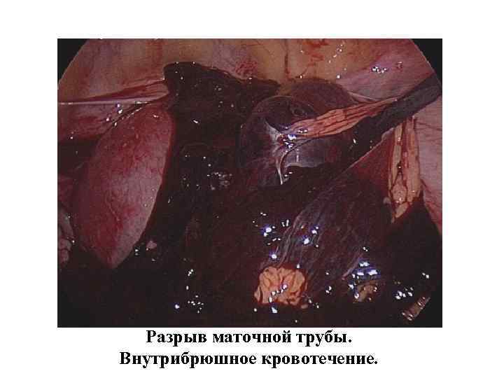 Разрыв маточной трубы. Внутрибрюшное кровотечение. Разрыв маточной трубы. Внутрибрюшное кровотечение.
