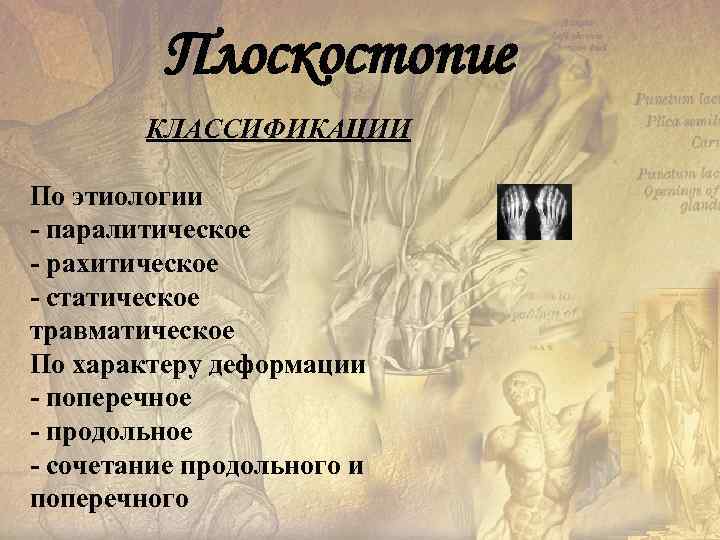    Плоскостопие   КЛАССИФИКАЦИИ       По
