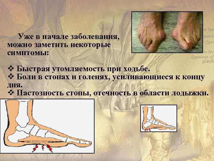  Уже в начале заболевания,  можно заметить некоторые симптомы: v Быстрая утомляемость при