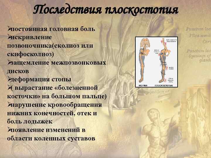   Последствия плоскостопия Øпостоянная головная боль Øискривление позвоночника(сколиоз или скифосколиоз) Øзащемление межпозвонковых дисков