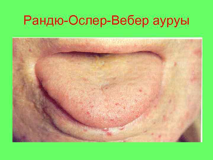 Рандю-Ослер-Вебер ауруы 