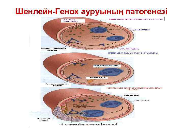 Шенлейн-Генох ауруының патогенезі 