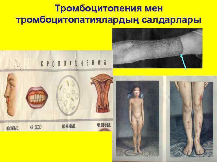   Тромбоцитопения мен тромбоцитопатиялардың салдарлары 