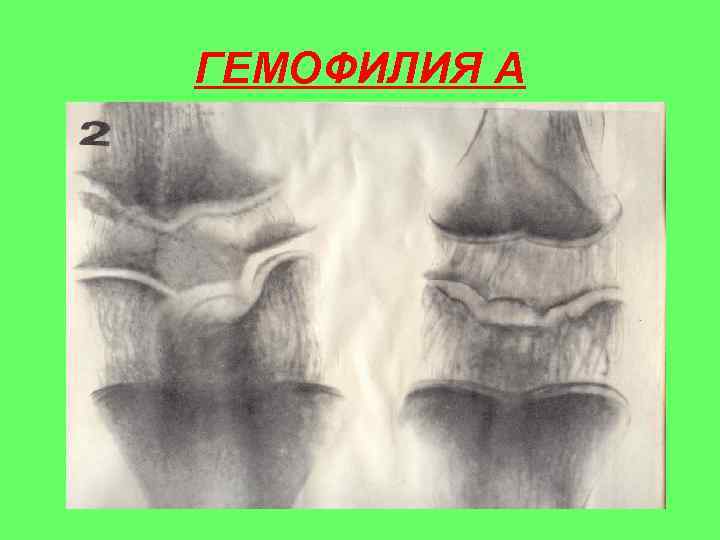 ГЕМОФИЛИЯ А 