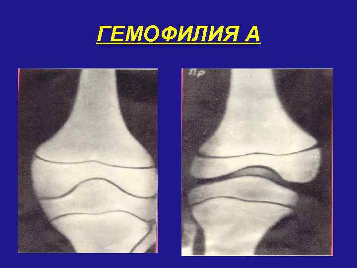 ГЕМОФИЛИЯ А 