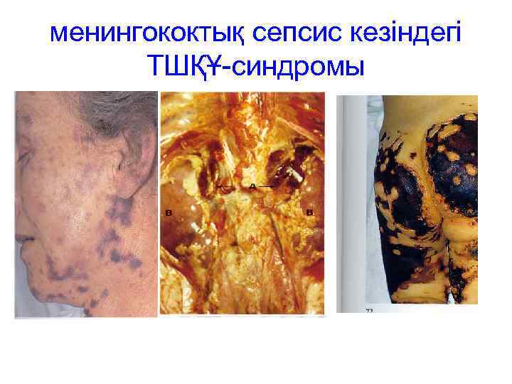 менингококтық сепсис кезіндегі  ТШҚҰ-синдромы 