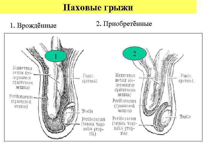     Паховые грыжи 1. Врождённые   2. Приобретённые  