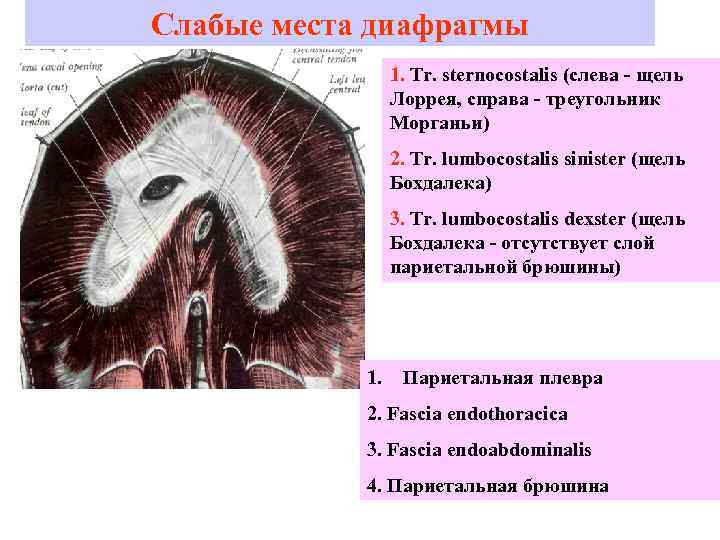 Слабые места диафрагмы   1. Tr. sternocostalis (слева - щель   Лоррея,