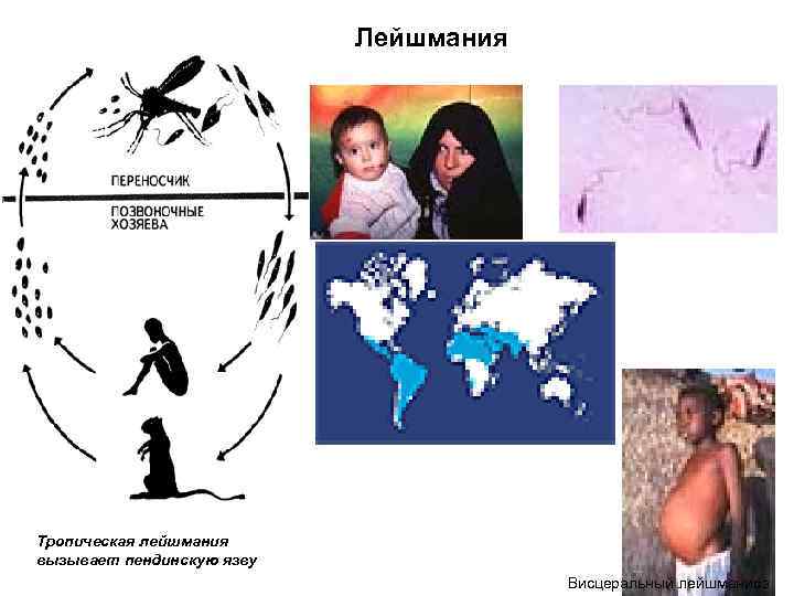       Лейшмания Тропическая лейшмания вызывает пендинскую язву  