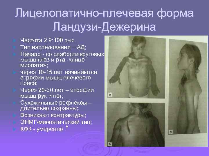 Лицелопатично-плечевая форма  Ландузи-Дежерина Ø  Частота 2, 9: 100 тыс. Ø  Тип