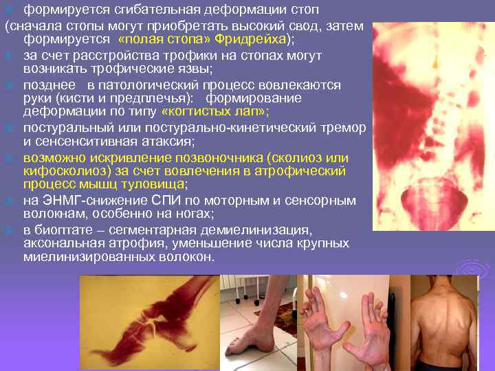 Ø формируется сгибательная деформации стоп (сначала стопы могут приобретать высокий свод, затем  формируется