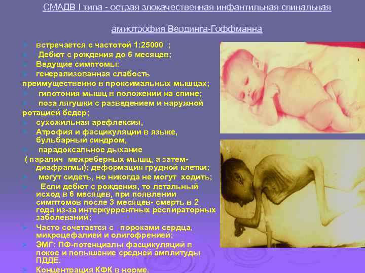   СМАДВ I типа - острая злокачественная инфантильная спинальная    