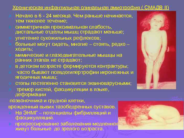   Хроническая инфантильная спинальная амиотрофия ( СМАДВ II) Ø Начало в 6 -