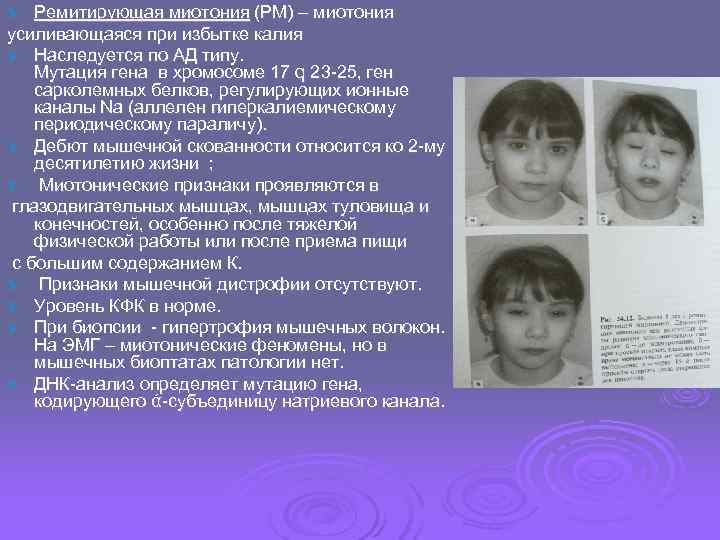 Ø  Ремитирующая миотония (РМ) – миотония усиливающаяся при избытке калия Ø Наследуется по