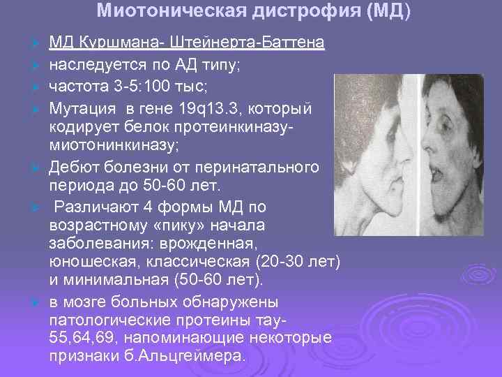 Миотоническая дистрофия презентация