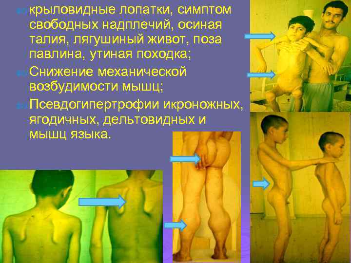  крыловидные лопатки, симптом  свободных надплечий, осиная  талия, лягушиный живот, поза 