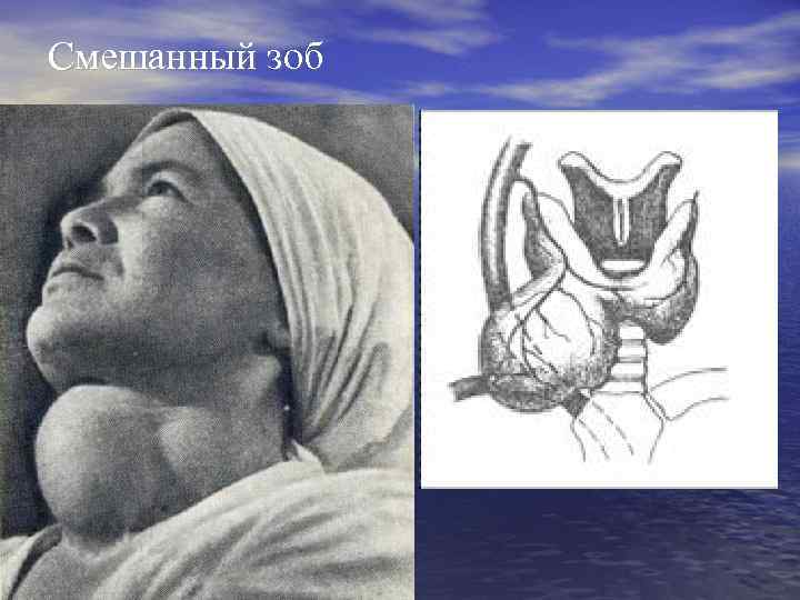 Смешанный зоб 