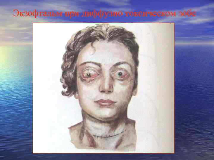 Экзофтальм при диффузно токсическом зобе 