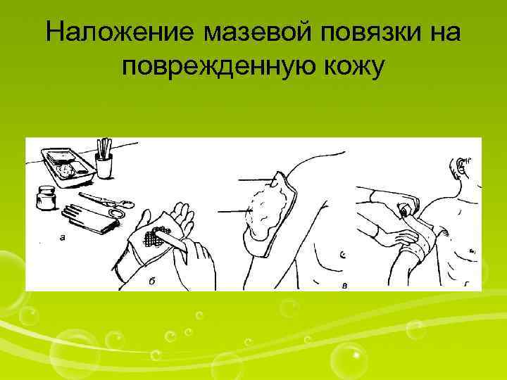 Наложение мазевой повязки на поврежденную кожу 