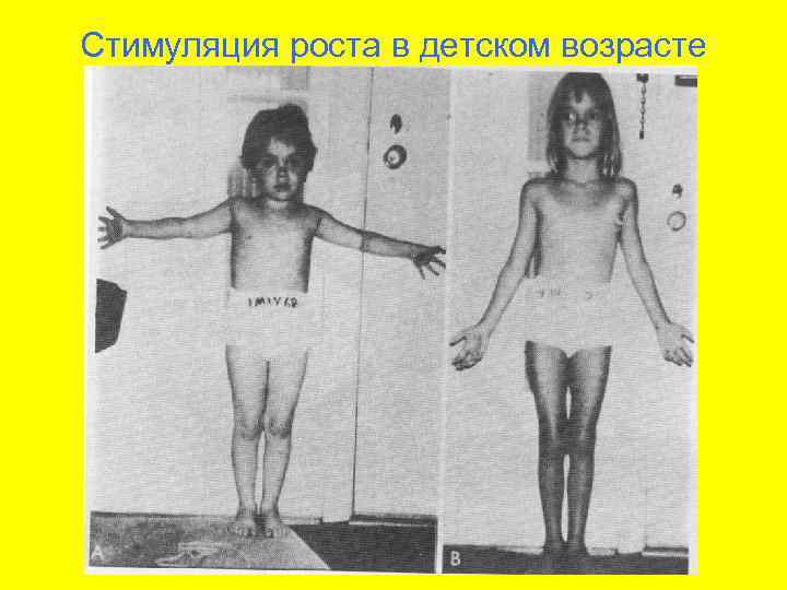 Стимуляция роста в детском возрасте 