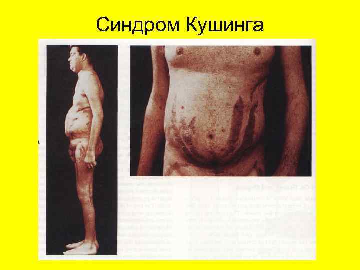 Синдром Кушинга 