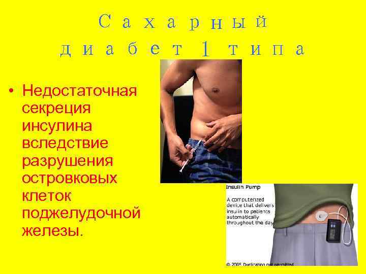   Сахарный диабет 1 типа • Недостаточная  секреция  инсулина  вследствие